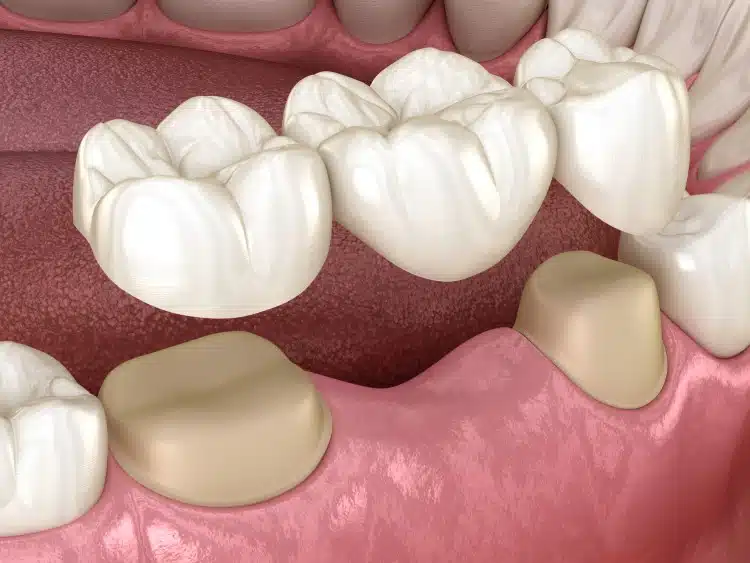 Chi phí làm cầu răng với bảo hiểm nha khoa là bao nhiêu?