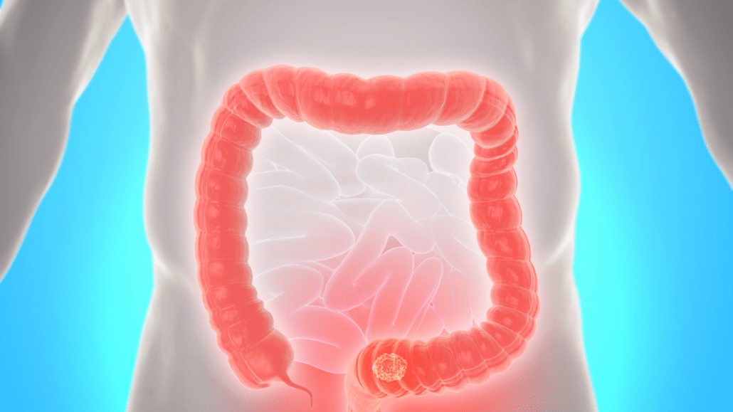 Why you need an early screening for colon cancer